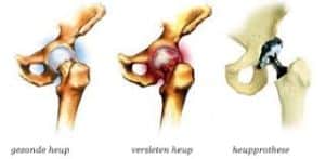 nieuwe heup, heupoperatie