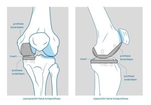 knievervangende operatie, nieuwe knie, knieprothese