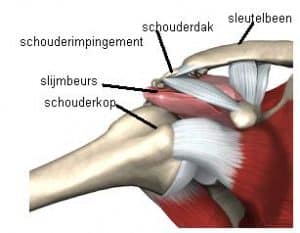 schouderoperatie, schouder operatie